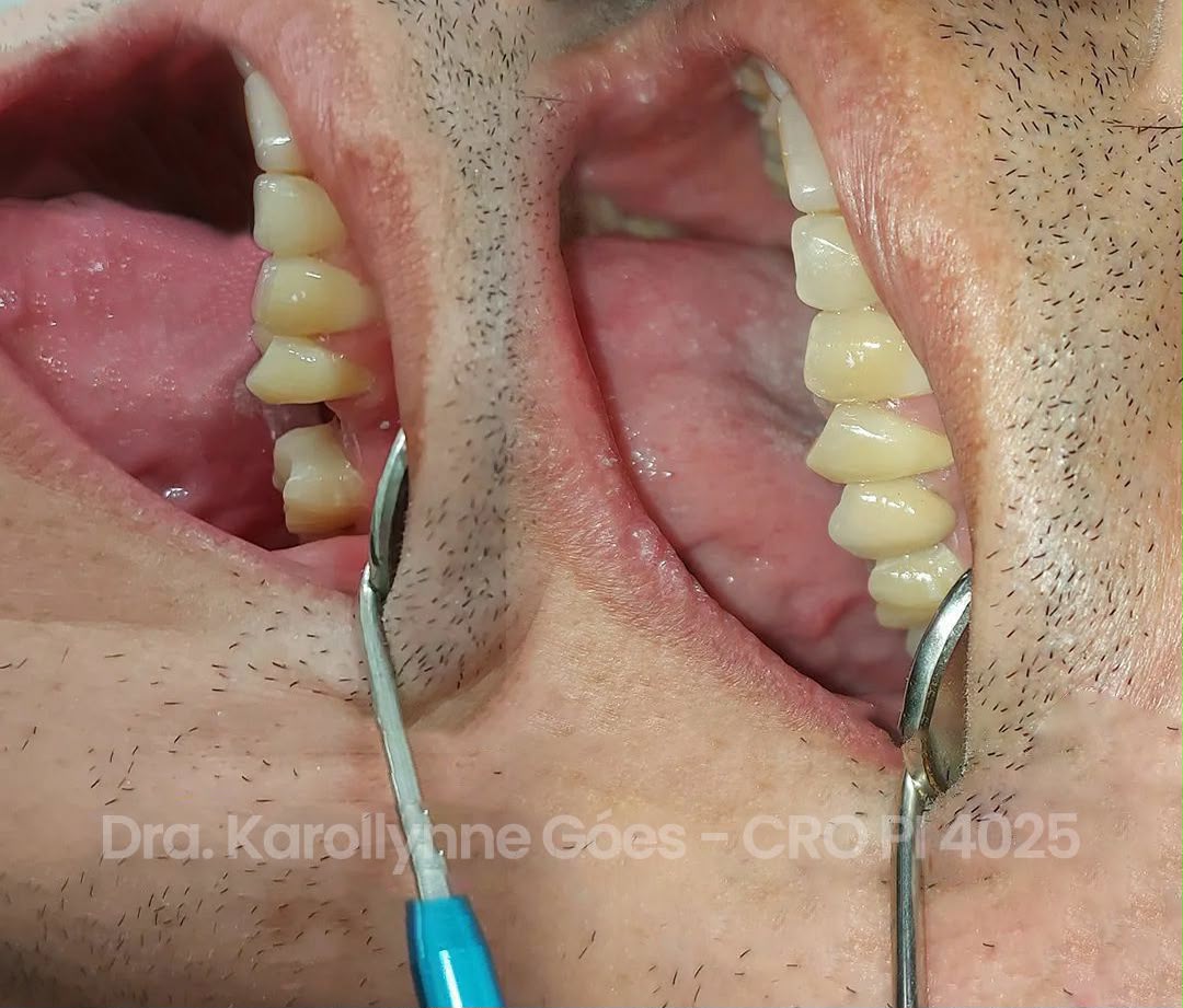 Implante dentário com coroa de cerâmica